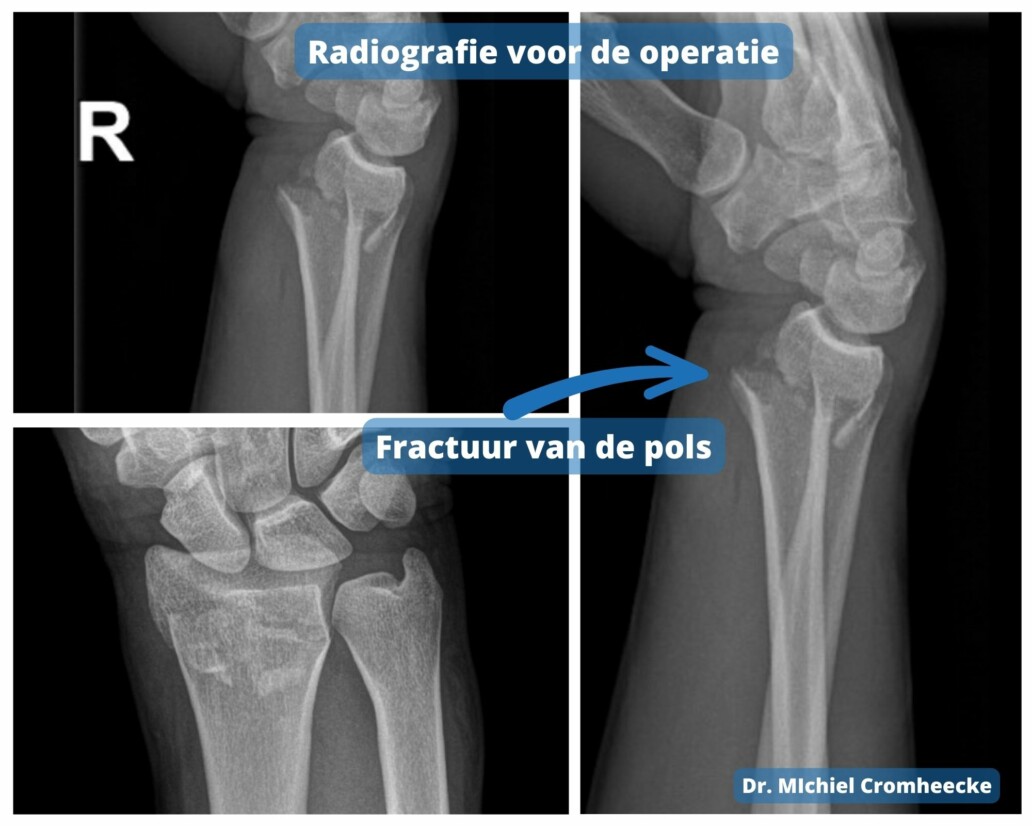 Gebroken Pols Polsfractuur Dr Michiel Cromheecke